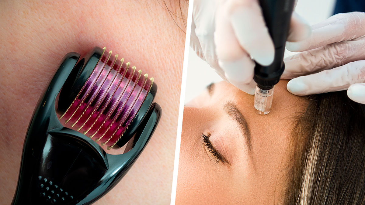 Microneedling With PRP Before and After Results + Photos